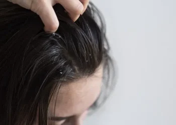 Cara Mengatasi Ketombe Membandel Menurut Ahli