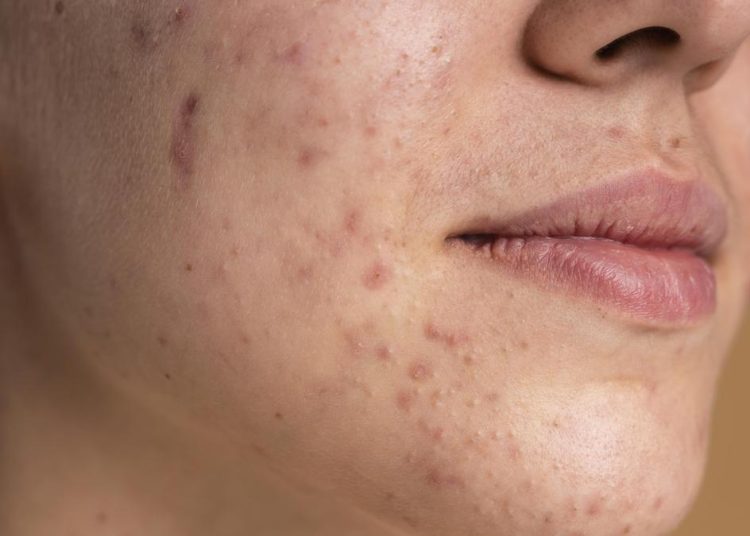 Penyebab Jerawat Sering Muncul di Dahi, Pipi, dan Dagu