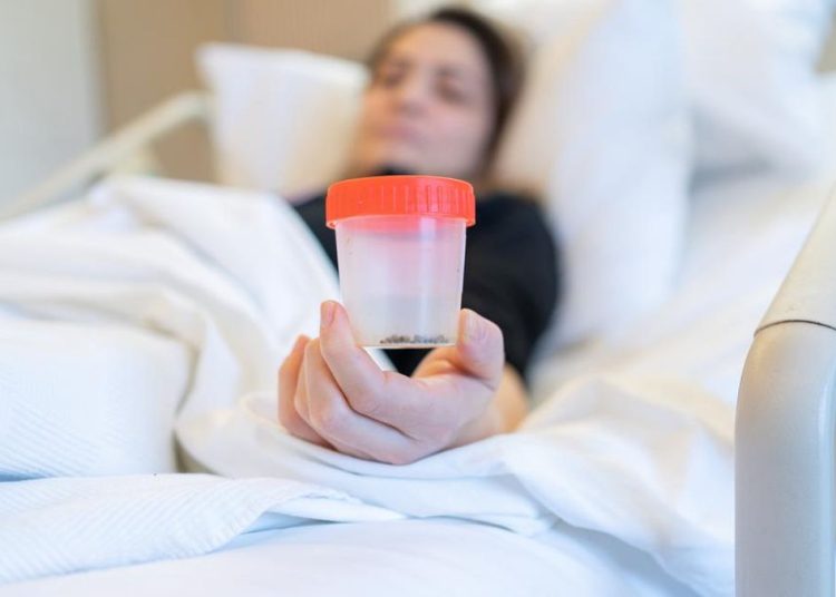 Apakah Batu Ginjal Bisa Keluar Sendiri Melalui Urine? Simak Penjelasannya