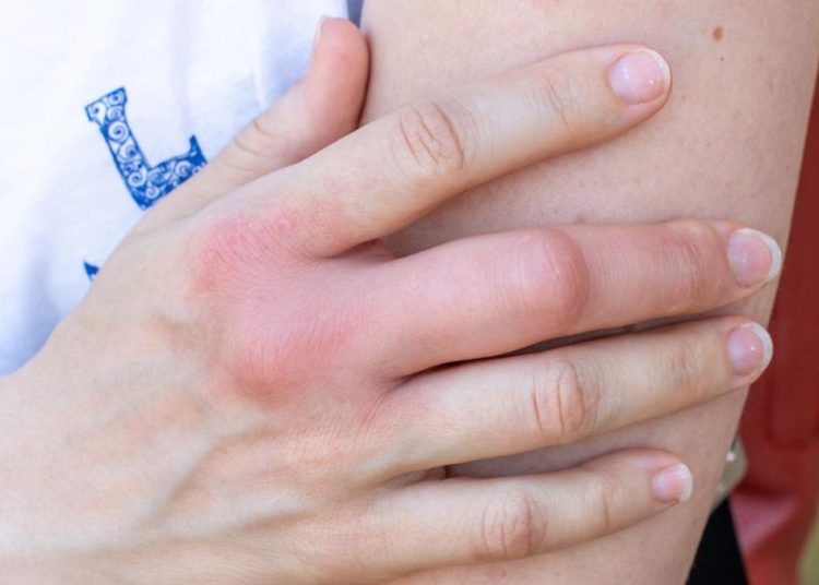 Wasapada 5 Tanda Kerusakan Ginjal yang Terlihat di Kulit