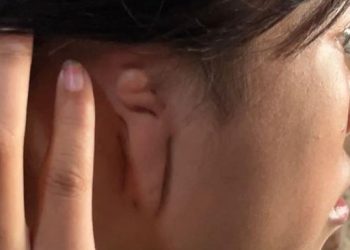 China Buat Sejarah Baru, Telinga Terputus Dipasang di Kaki